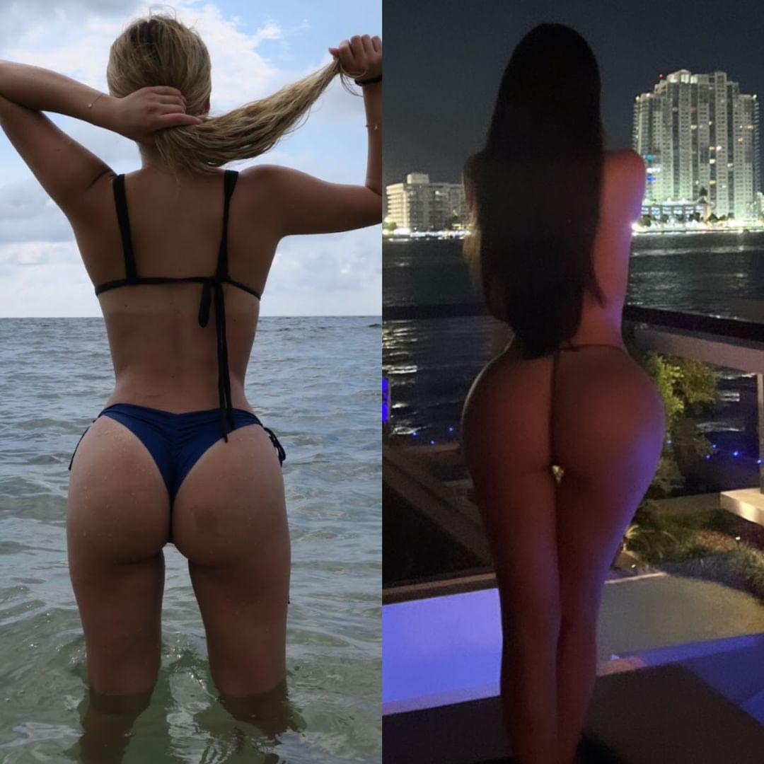 Real patient before and after Brazilian Butt Lift (BBL) and Lipo 360 at Vive Plastic Surgery Tijuana